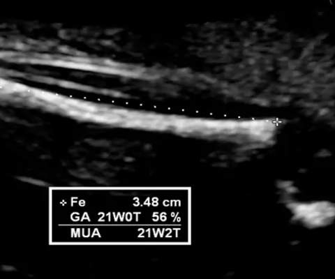 Hình ảnh siêu âm chiều dài xương đùi thai nhi xem thai nhi có đang phát triển bình thường hay không