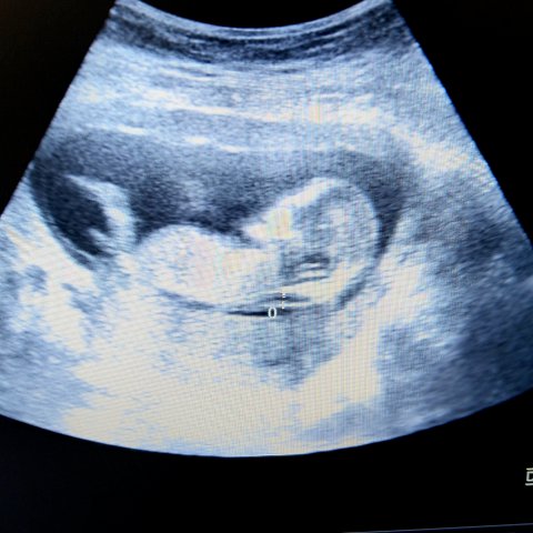 hinh-anh-sieu-am-do-do-mo-da-gay