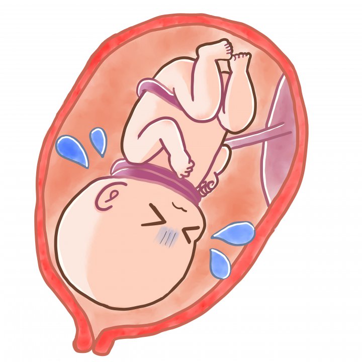The,Umbilical,Cord,Gets,Wrapped,Around,The,Baby’s,Neck,;