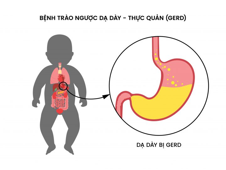 Bệnh trào ngược dạ dày - thực quản (GERD)